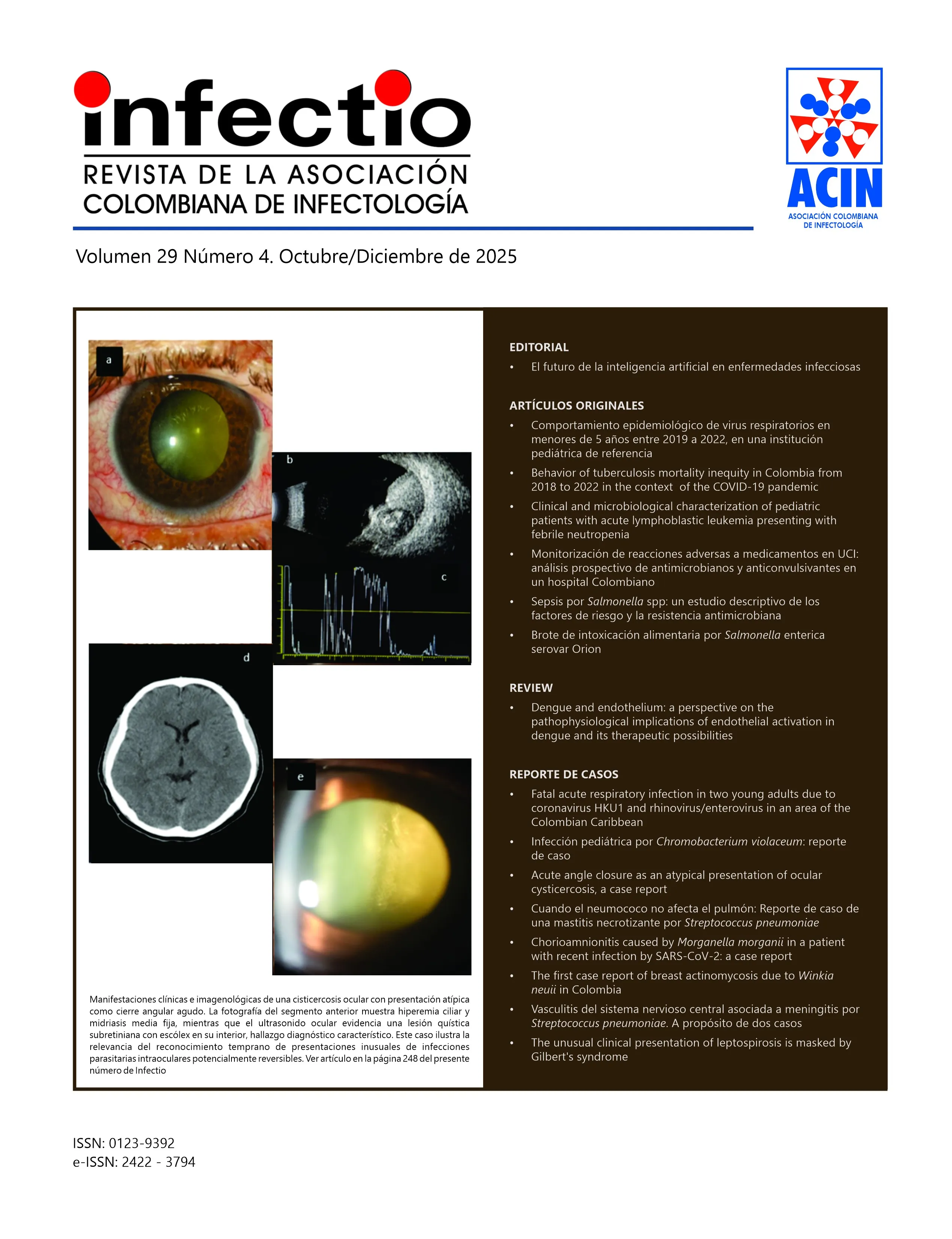 Mastitis Necrotizante - Noticia Internacional